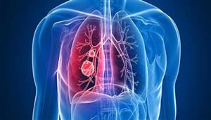 أعراضه لا تظهر في المراحل المبكرة.. علامات تدل على الإصابة بسرطان الرئة