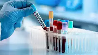 فحص دم يتنبأ بسرطان الرأس والرقبة قبل ظهوره بـ 10 سنوات