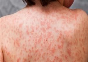 هل يظهر الطفح الجلدي على الأطفال بعد الإصابة بـRSV؟- أطباء يجيبون 