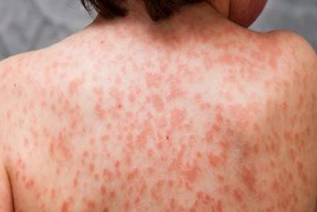 علاجات منزلية بسيطة تخلصك من الطفح الجلدي