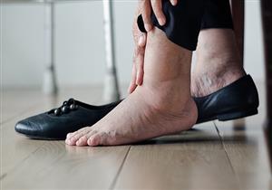 تجلط الأوردة العميقة مرض خطير- كيف تكتشف الإصابة به؟