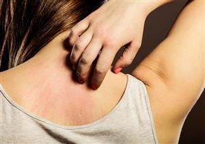 طرق علاج حكة الجلد في المنزل - متى تذهب للطبيب؟