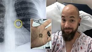 فقدها من 5 سنوات.. رجل يعثر على حلقة أنف في رئته