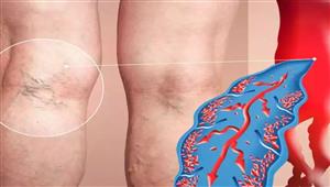 علامات موجودة على ساقك تشير إلى تجلط الدم
