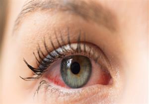 جلطات العين.. أعراضها وكيفية اكتشافها وعلاجها والإسعافات الأولية لتجنب المضاعفا