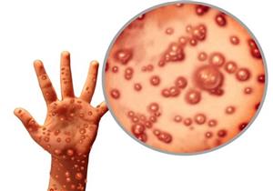 أول إصابة بجدري القرود في مصر- "الصحة" تكشف تفاصيل حالة المريض