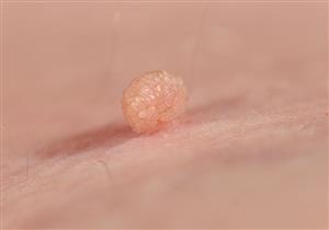 زيت طبيعي يقضي على الزوائد الجلدية بسهولة