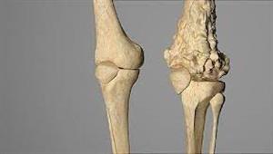   إذا شعرت بهذه العلامات فأنت مصاب بنوع نادر من السرطان 