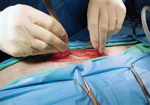 حسام موافي يحذر: استئصال الطحال ممنوع في هذه الحالة