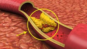 تظهر عند الاستيقاظ من النوم.. علامات تحذيرية خطيرة لانسداد الشرايين