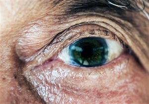 طبيبة تكشف عن أخطر مريض يصيب العين