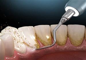 هل بيكربونات الصوديوم آمنة لإزالة طبقة البلاك؟