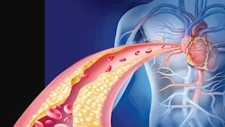 كيف تؤثر مستويات الكوليسترول على الدماغ؟