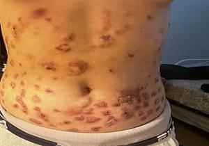 حقن تفتيت الدهون تشوه جسم فتاة تمامًا