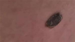 رجل يكشف إصابته بسرطان الجلد بطريقة غير متوقعة.. احذر الأعراض