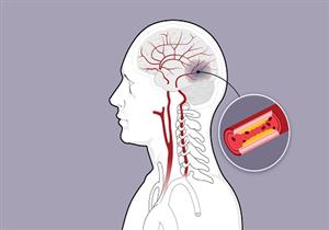 السكتة الدماغية- 9 فئات أكثر عرضة للإصابة بها