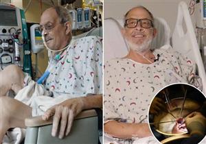 وفاة ثاني حالة بعد عملية زرع قلب خنزير