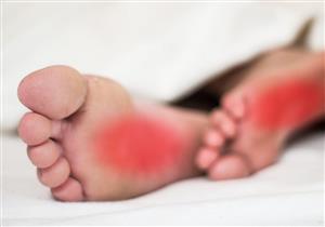 تنميل القدمين أثناء النوم- طبيب يحذر: عرض لهذه الأمراض