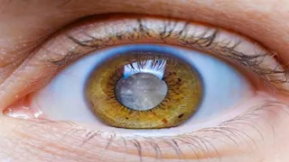 صحتك في رمضان| الجلوكوما بعد الأربعين.. هل أنت ضمن الفئة الأكثر عرضة؟