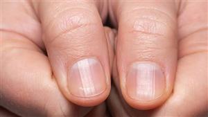 احذر هذه العلامات.. أظافرك تخبرك بكارثة عن كليتك