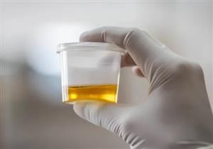 حسام موافي يوصي هؤلاء بإجراء تحليل البول بشكل دوري