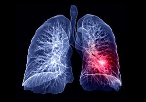   5 أعشاب تساعد على تنظيف الرئتين بشكل طبيعي