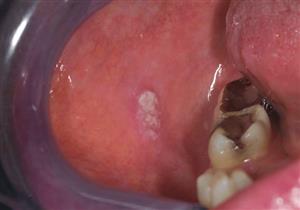 طبيبة تحذر من سرطان تجويف الفم: هذه أعراضه