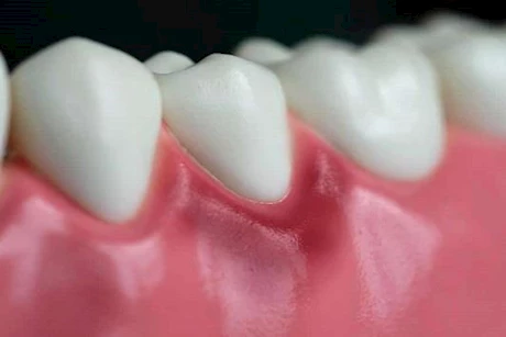 فوائد زيت جوز الهند.. كنز طبيعي لعلاج التهاب اللثة