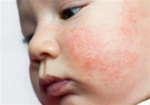 احذري- مرض جلدي ليس له علاج قد يصيب رضيعك