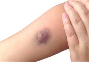 هل يتسبب الحزن في ظهور كدمات بالجسم؟