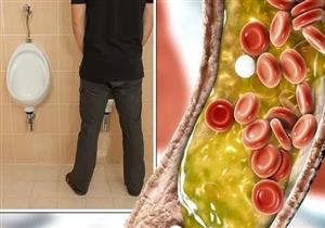 هل ارتفاع الكوليسترول يسبب كثرة التبول؟- طبيب يجيب