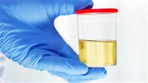 هل رائحة البول القوية دلالة على الإصابة بمرض معين؟ 