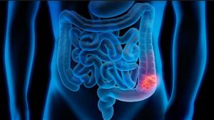 أطعمة ومشروبات تضر القولون.. على المرضى تجنبها 