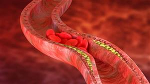 احذر.. 3 علامات تكشف أن ألم الساق ناتج عن ارتفاع الكوليسترول في الدم 