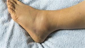 حسام موافي يكشف عن سبب تورم القدمين.. احذرها