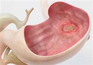 طبيب يكشف عن أدوية تسبب قرحة المعدة "فيديو"