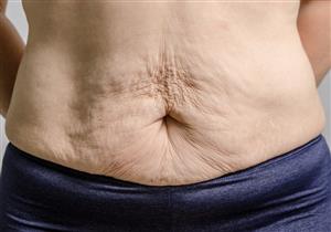 الجلد المترهل بعد فقدان الوزن- كيف تتخلص منه؟ "فيديو"