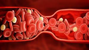 علامات تحذيرية تدل على وجود جلطة دموية.. احذر هذا الأمر 
