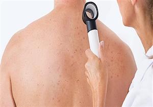 طرق طبيعية للتخلص من البثور السوداء في الظهر