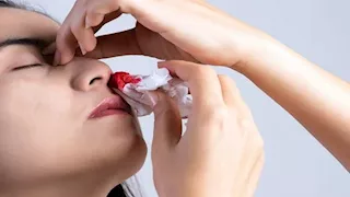 نزيف الأنف علامة تكشف ارتفاع ضغط الدم المرتفع.. لا تتجاهلها
