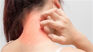 "اكتشفها على قدميك".. 4 أعراض صامتة لسرطان الجلد 