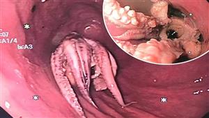 صدمة ورعب.. لن تتوقع ما وجده أطباء في مريء رجل سنغافوري 