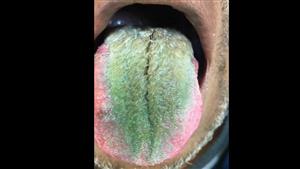 أغرب حالة طبية.. رجل أمريكي بلسان أخضر مشعر