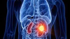  "تظهر في الليل".. 8 أعراض صامتة تكشف الإصابة بـ سرطان الكلى