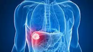 اعتقد أنه قرحة".. إصابة رجل بسرطان نادر في الكبد - احذر هذه الأعراض "