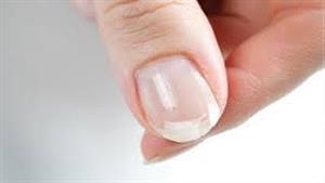 تغيّر شكل الأظافر قد تكون فى هذه الحالة علامة على سرطان مميت 