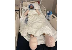 بسبب لدغة حشرة- بتر يدي وقدمي رجل أمريكي