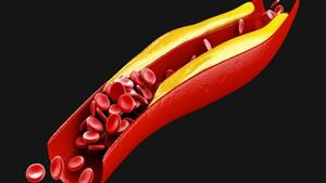 أشياء صادمة من روتينك اليومي تسبب ارتفاع مستويات الكوليسترول في الدم