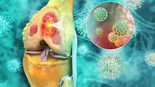 لا تتجاهلها.. 9 أعراض مبكرة لسرطان العظام