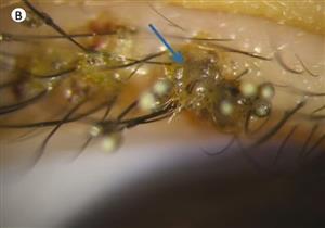 شعر بحكة العين- اكتشاف قمل في رموش مريض